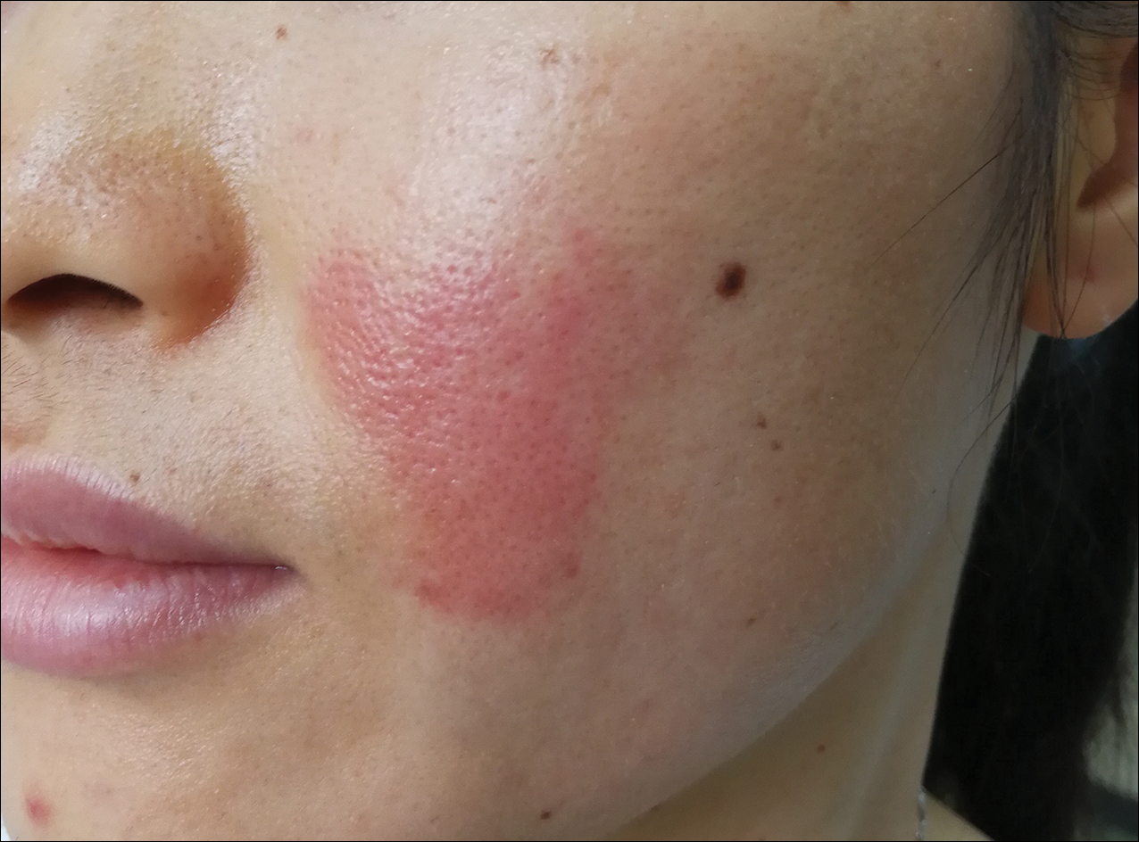 Dermatitis On Cheeks