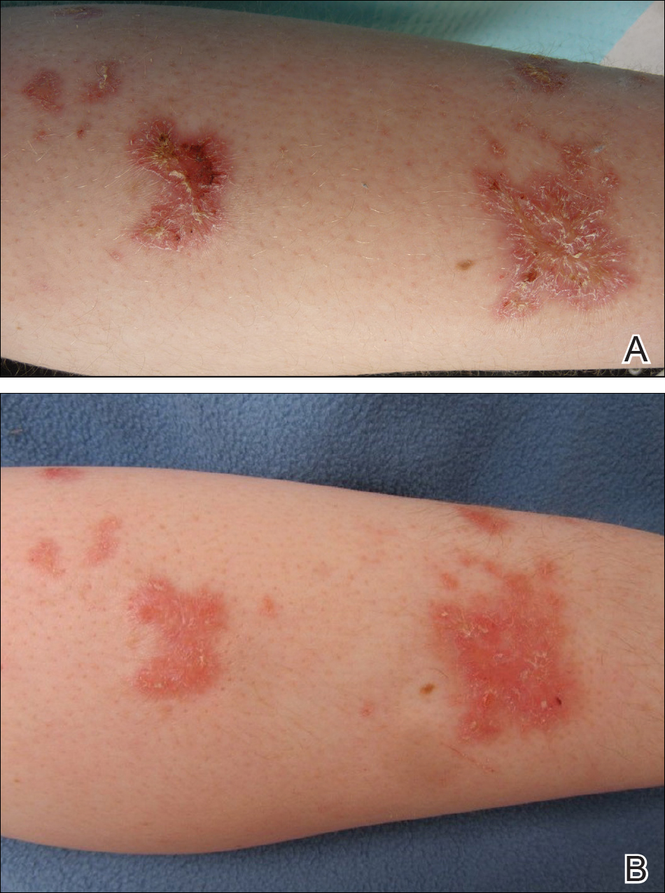 Inflammatory Linear Verrucous Epidermal Nevus Responsive To 308 Nm Excimer Laser Treatment Mdedge Dermatology