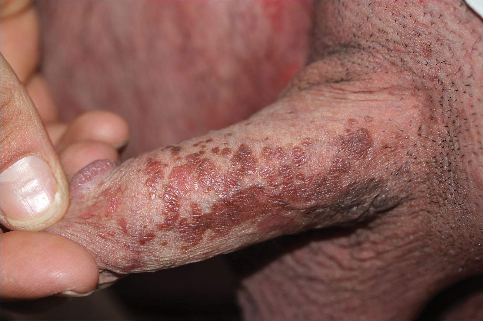 A 32-year-old man presented to the outpatient clinic with reddish brown les...