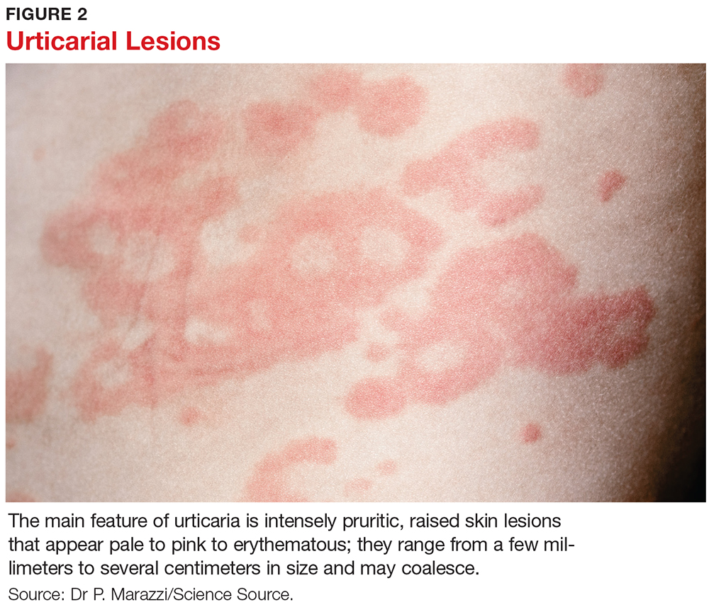 Idiopathic Skin Rash Chronic Hives Chronic Idiopathic Urticaria WCGG
