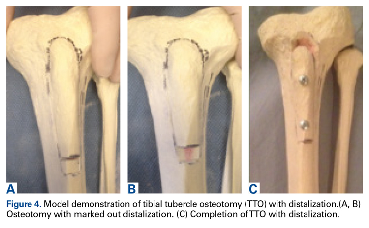 Tibial Tubercle Osteotomy Nhs Tibial Tubercle Osteotomy To Unload The 