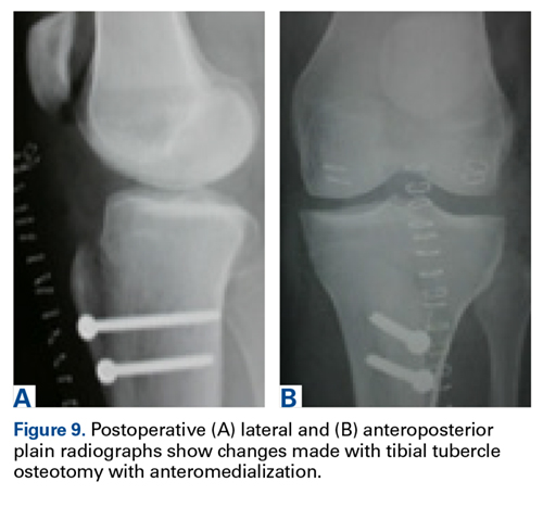 tibial tubercle osteotomy