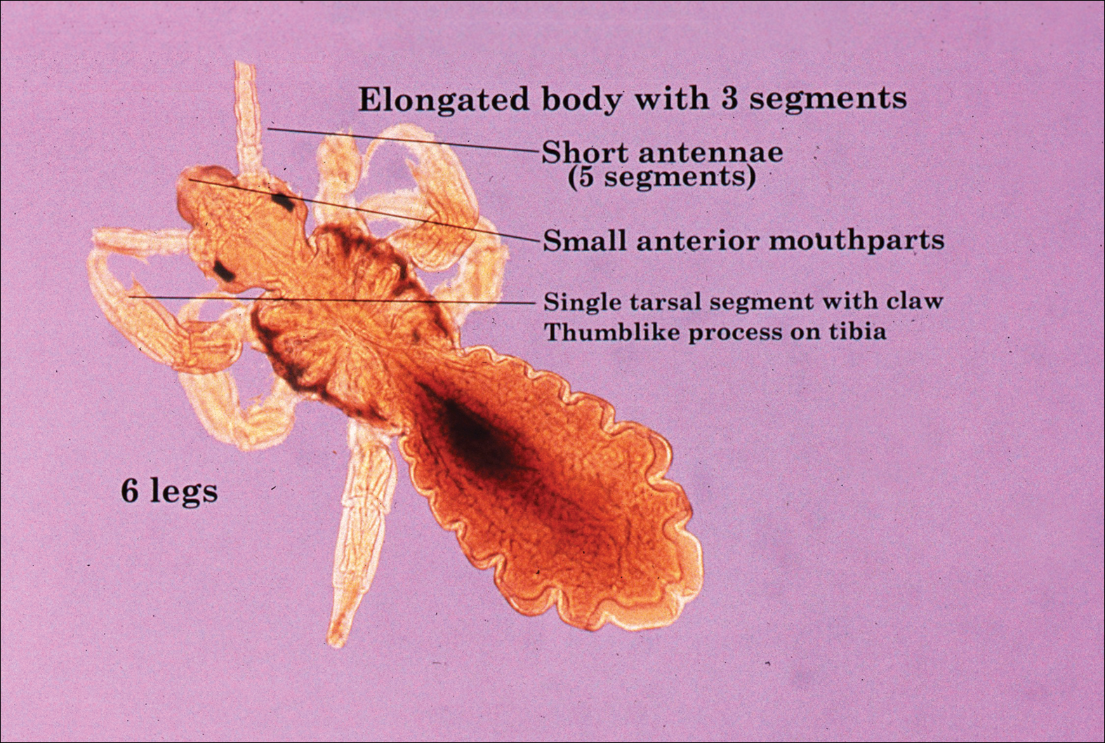 What's Eating You? Head Lice (Pediculus humanus capitis) | MDedge  Dermatology