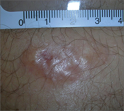 Painful Growing Lesion | MDedge Family Medicine