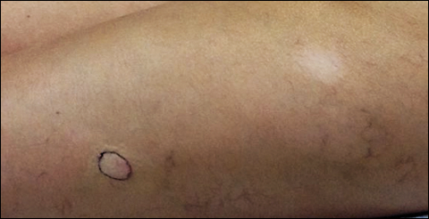 Hypopigmented Discoloration on the Thigh