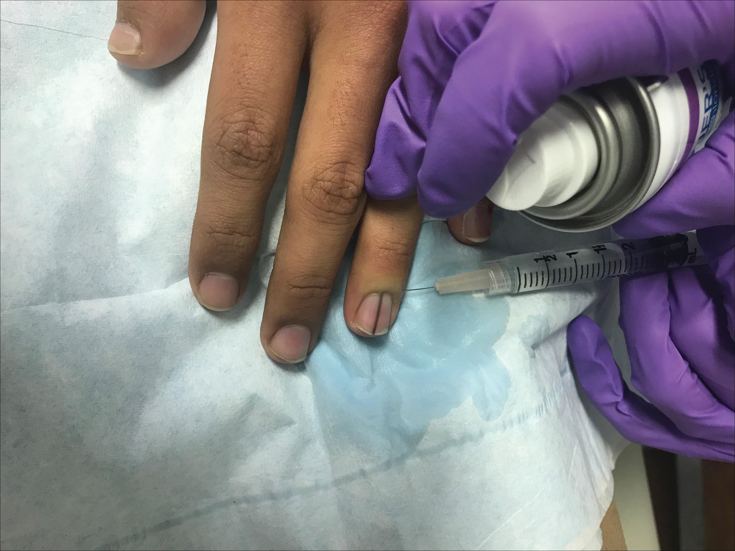 Pain-Minimizing Strategies for Nail Surgery | MDedge Dermatology