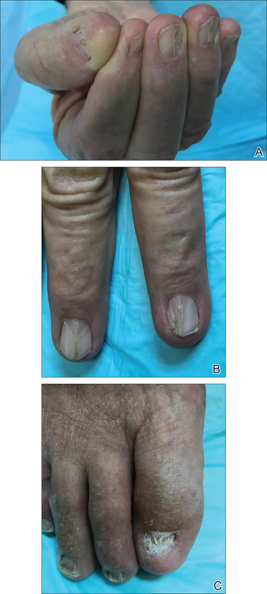 NAIL-PATELLA SYNDROME WITH NEPHROTIC SYNDROME AND DEAFNESS: A CASE REPORT |  Semantic Scholar