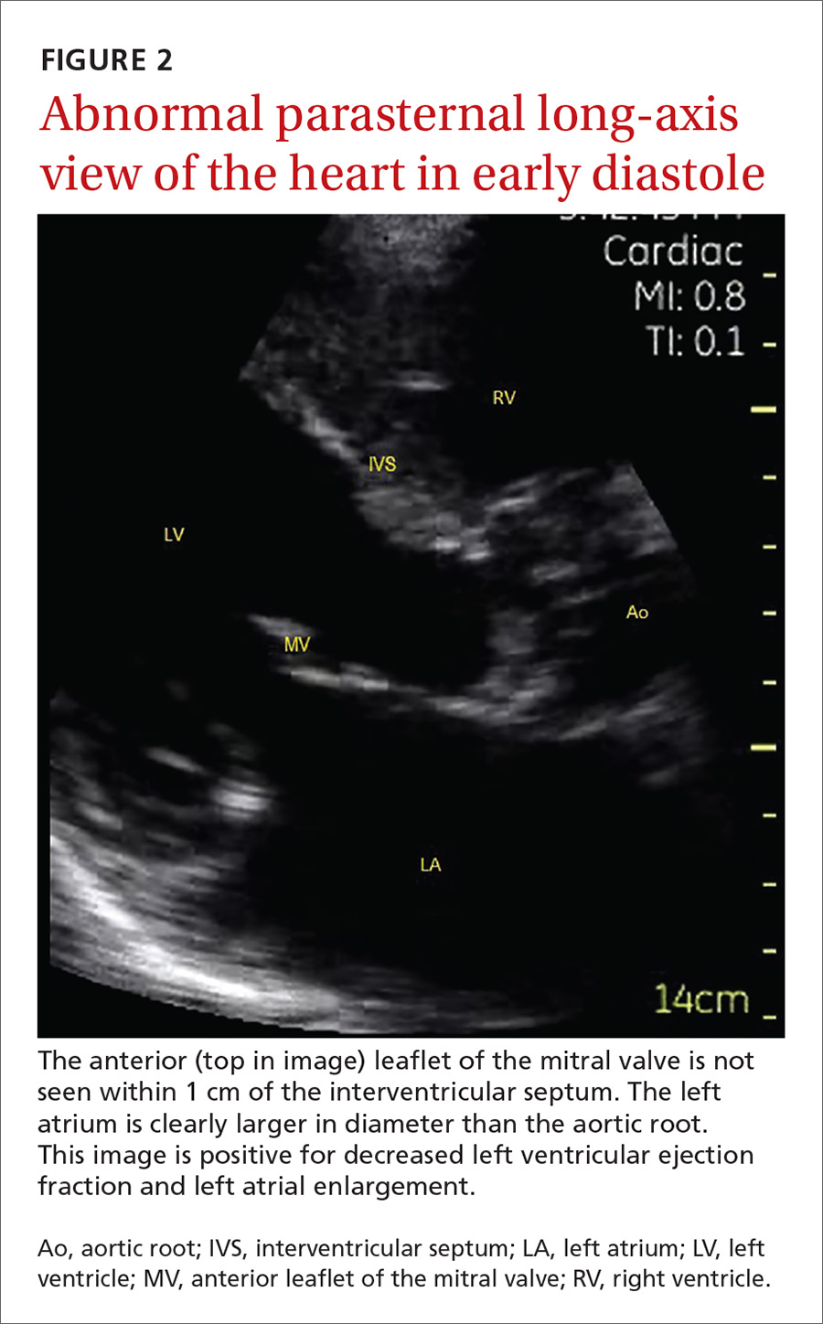 Abnormal parasternal long-axis view of the heart in diastole image