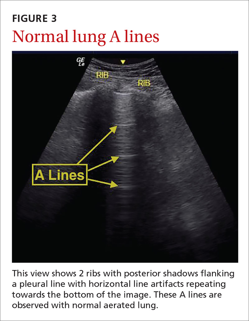 Normal lung A lines image