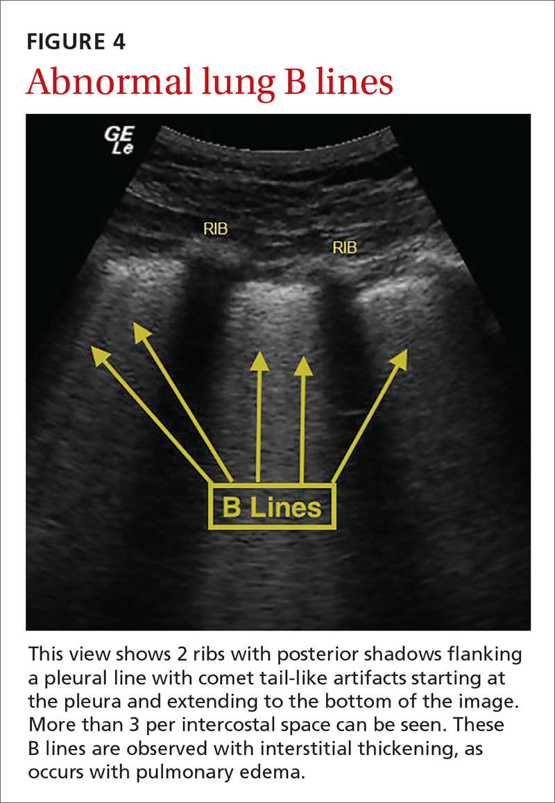 Abnormal lung B lines image