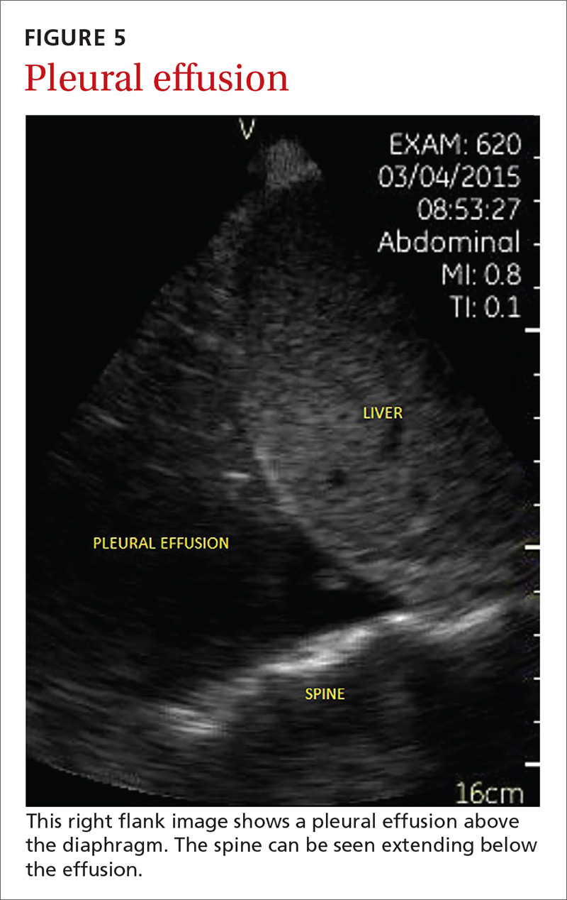 Pleural effusion image