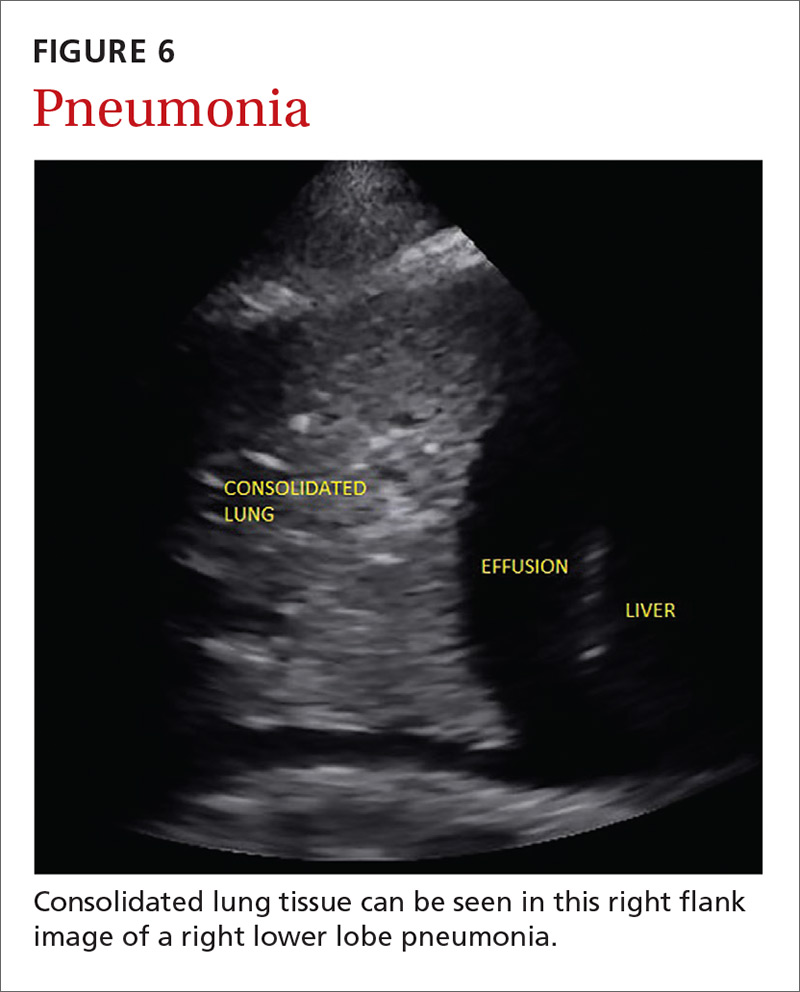 Pneumonia image