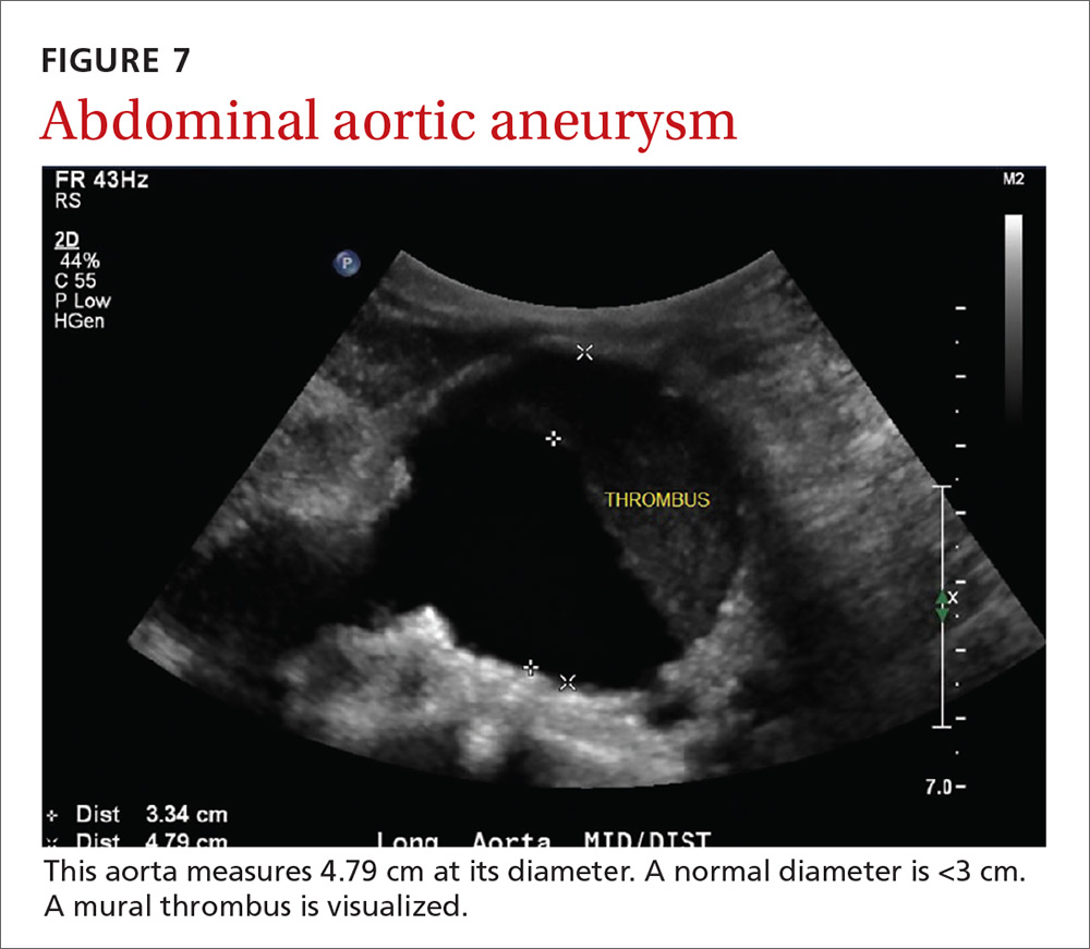 Abdominal aortic aneurysm image