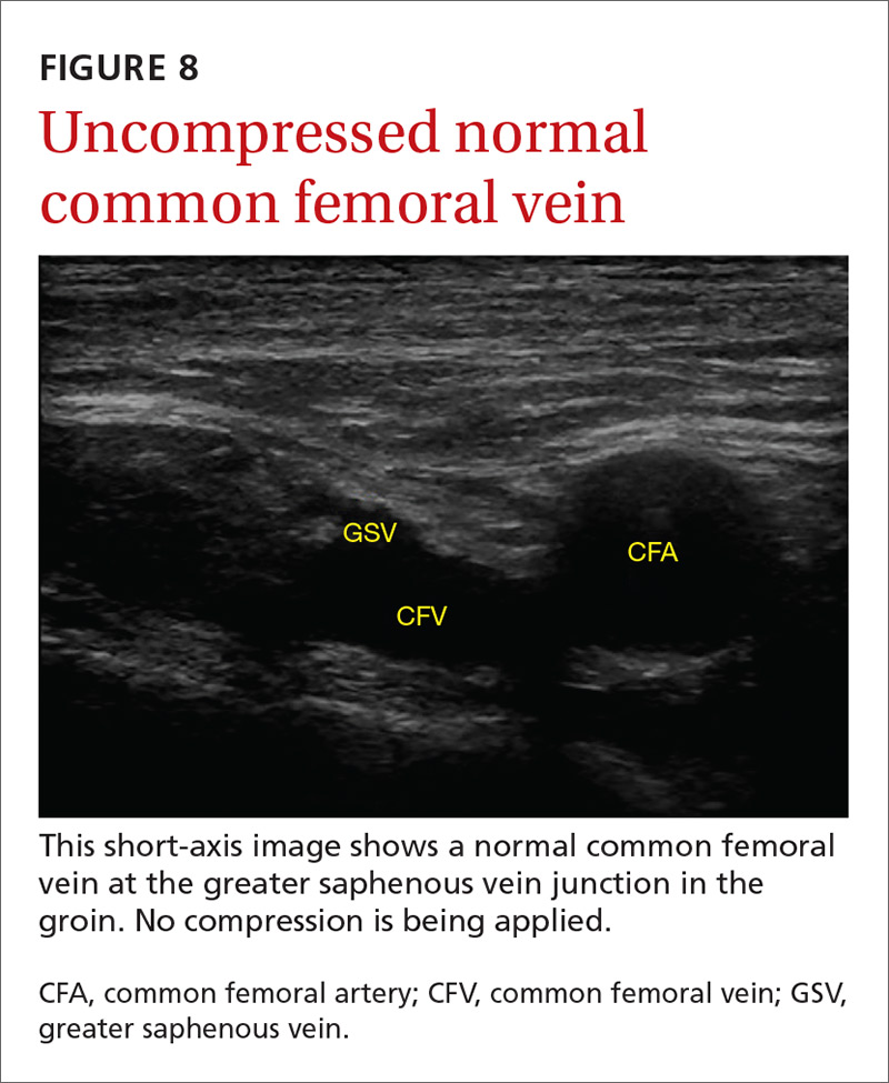 Uncompressed normal common femoral vein image