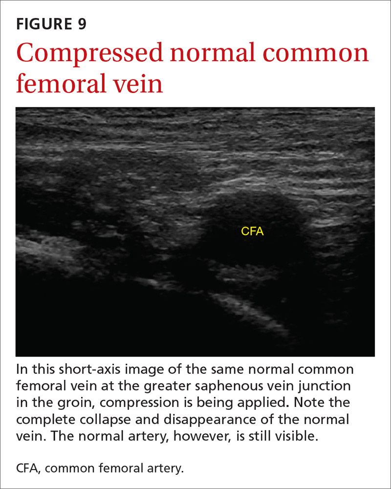 Compressed normal common femoral vein image