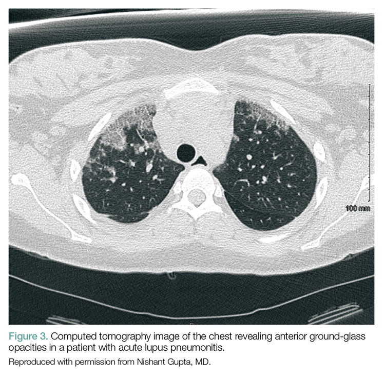 Complications of Systemic Lupus Erythematosus in the Emergency ...