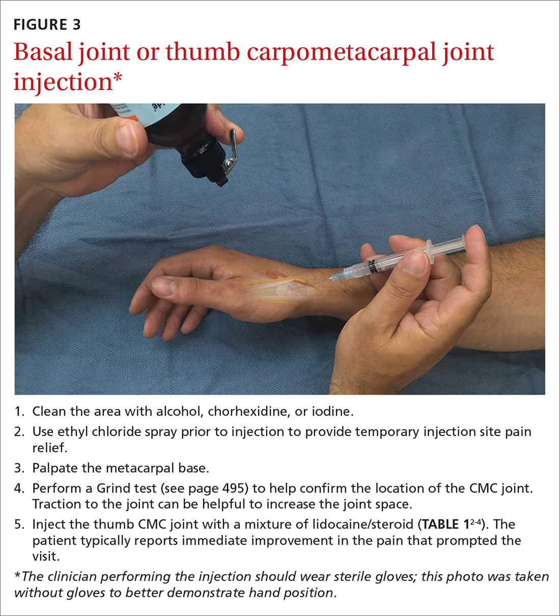 Carpal Metacarpal Joint Injection 3718