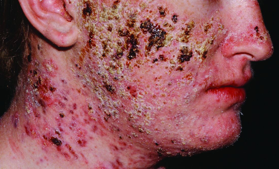 acne fulminans