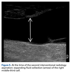 Lower Limb Morel-Lavallée Lesion Treated With Short-Stretch Compression ...