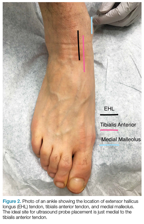 Emergency Ultrasound: Ultrasound-Guided Arthrocentesis of the Ankle