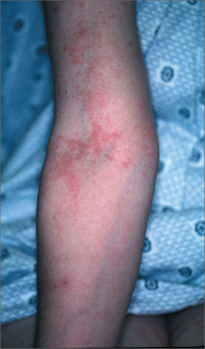 Itchy rash during pregnancy