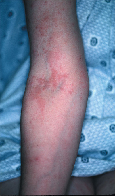 itchy-rash-during-pregnancy-mdedge-family-medicine