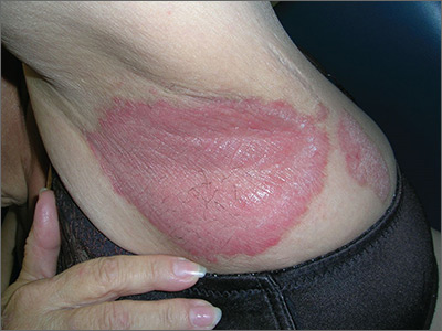 What Are These Erythematous Plaques In The Axillae?