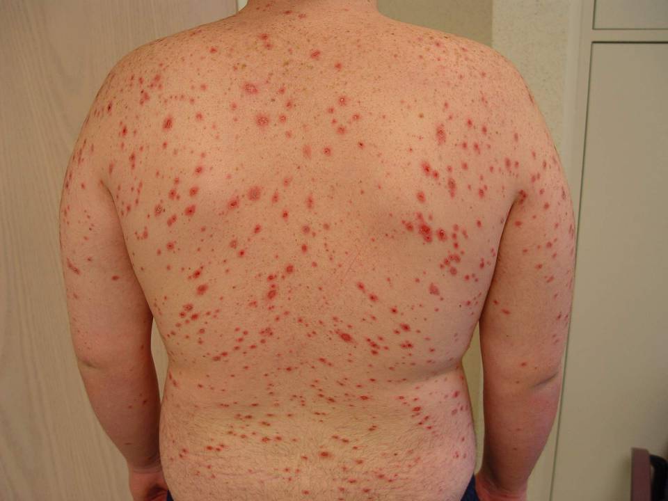 stevens johnson syndrome mild rash