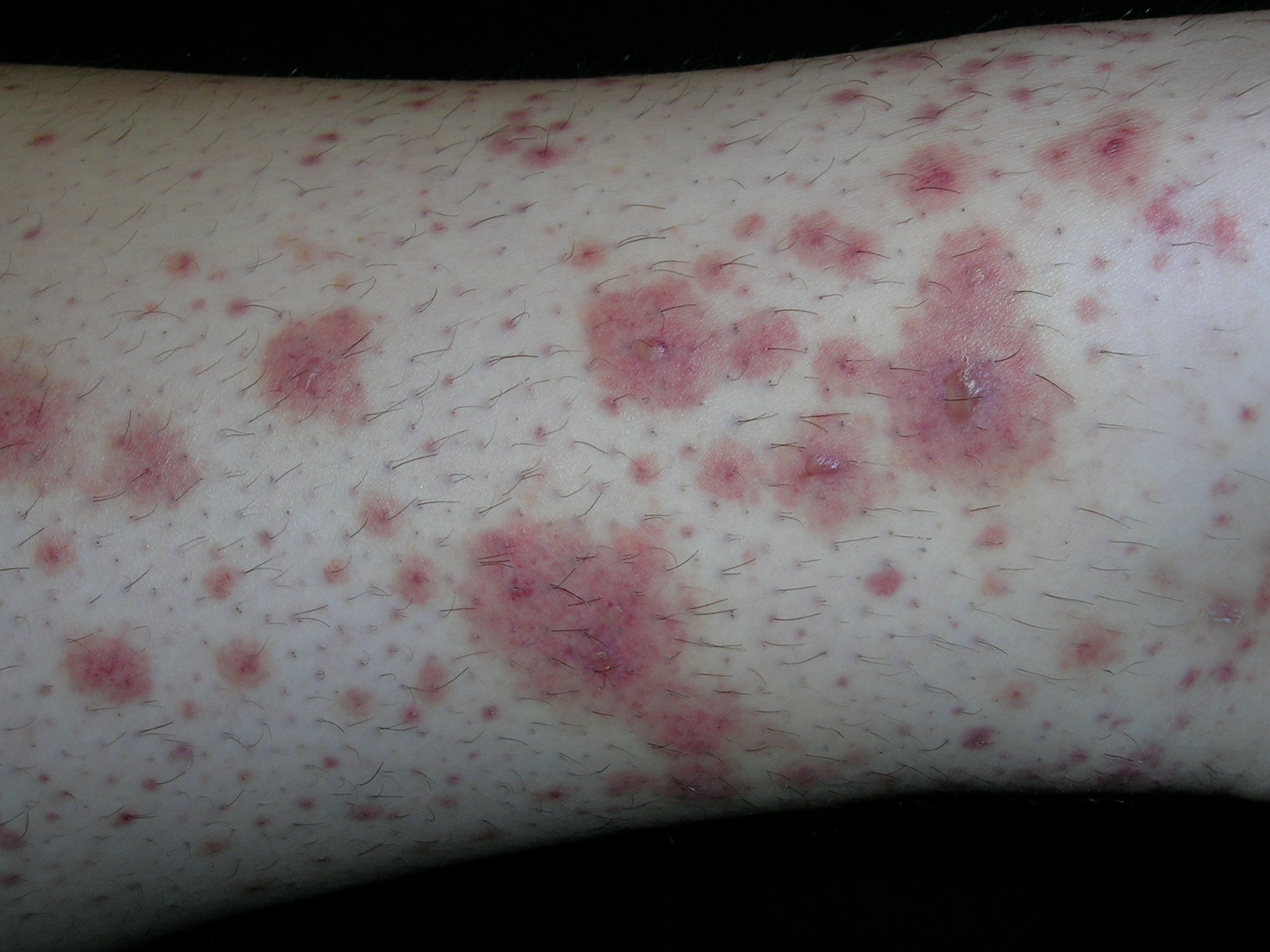 Rash On Extremities MDedge Family Medicine