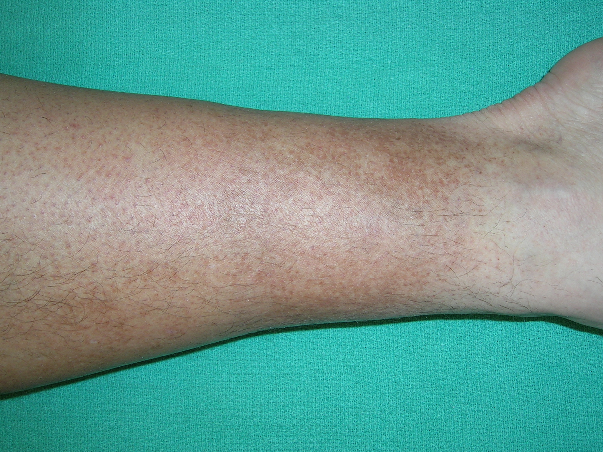 Discoloration of lower legs MDedge Family Medicine