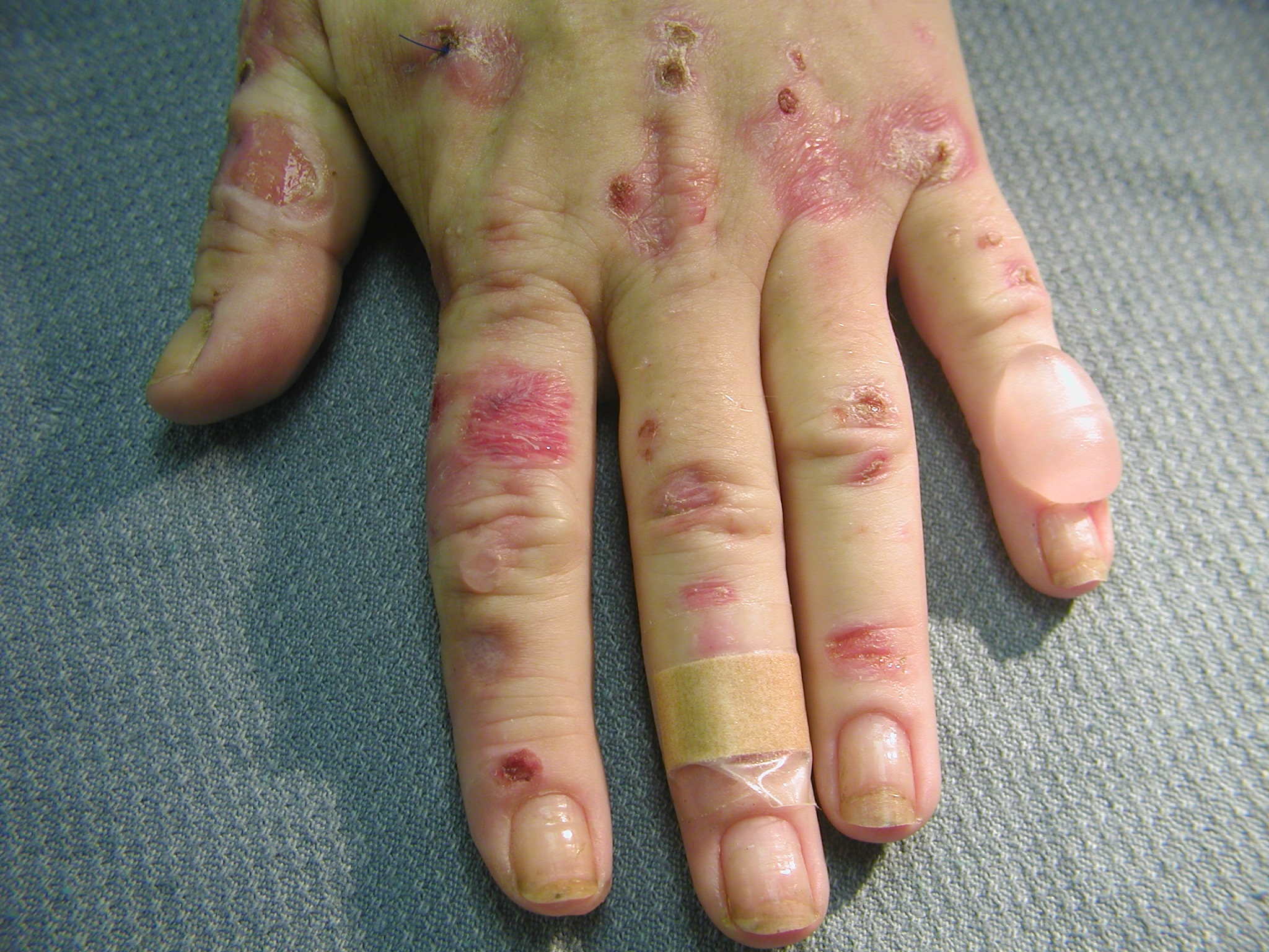 Blisters On Hands And Feet After Fever