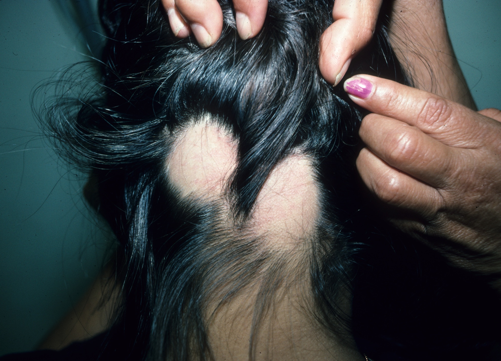 shaved chimpanzee with hair on head