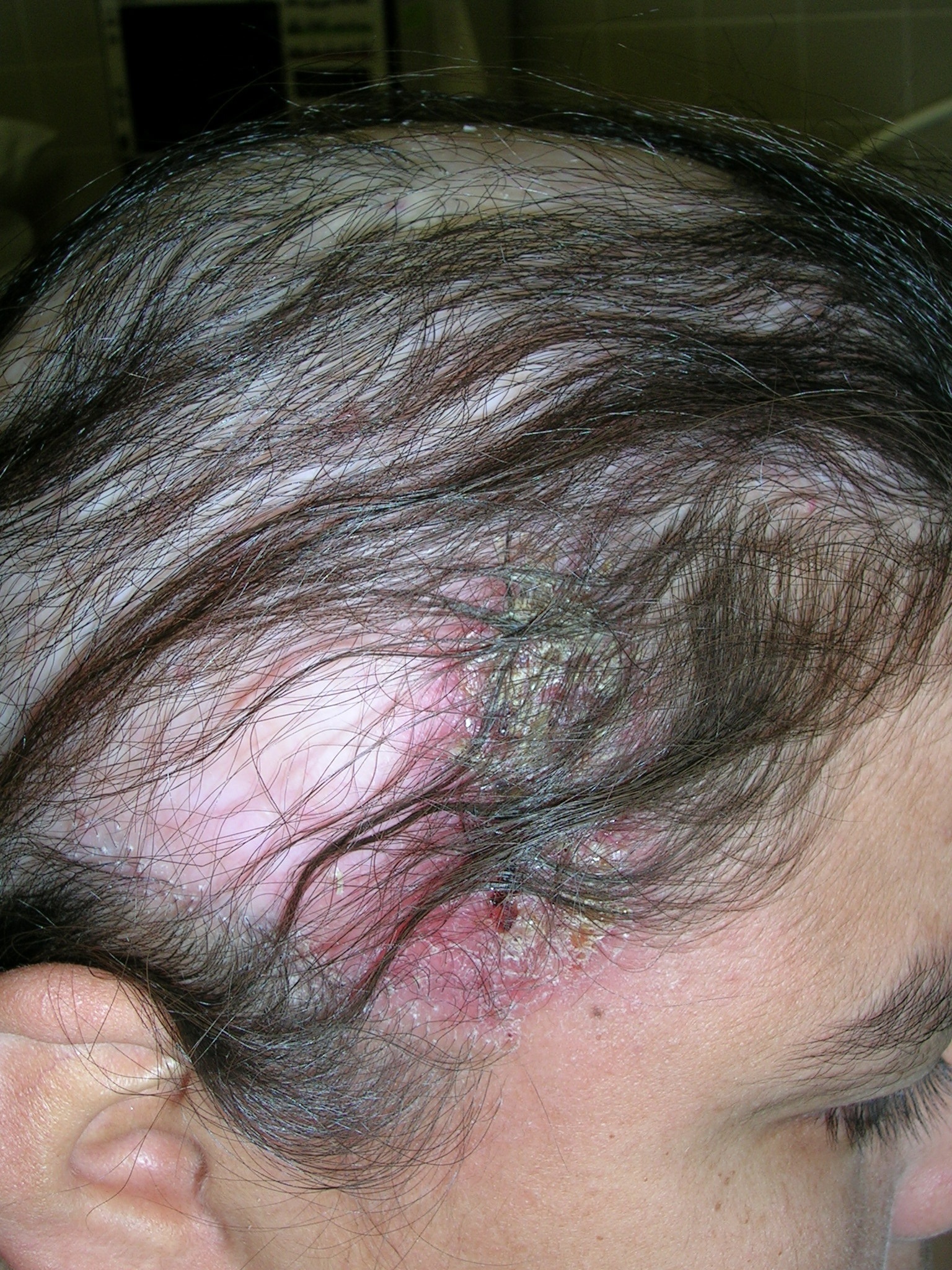 folliculitis hair loss