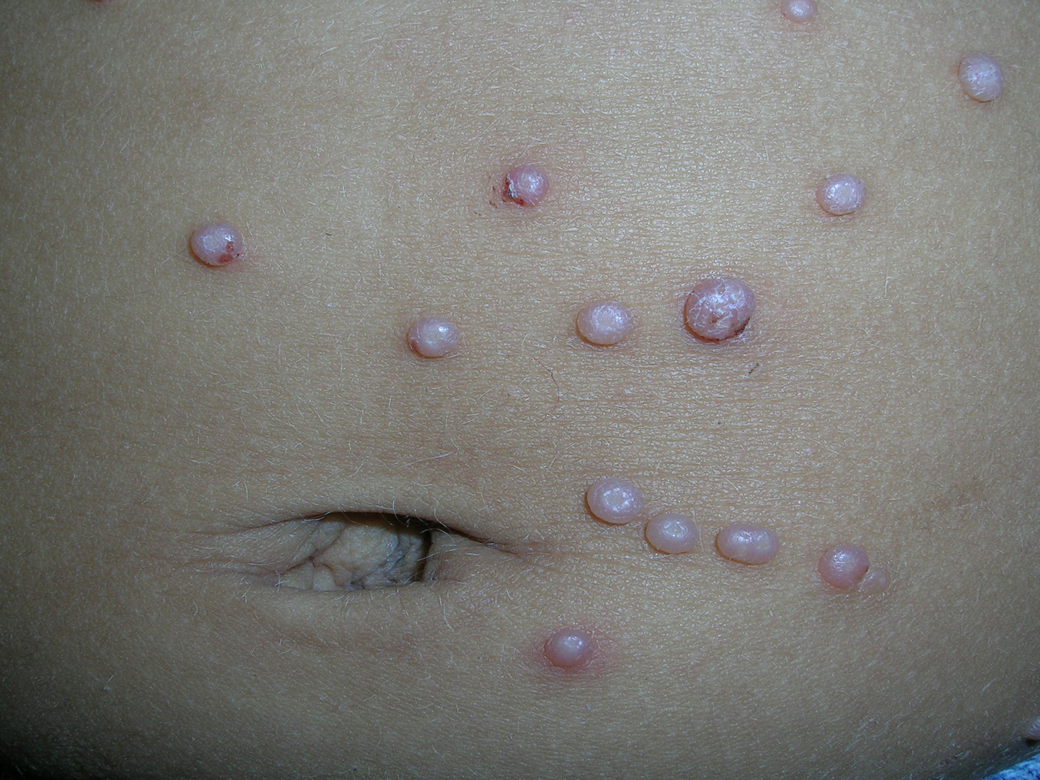 Red Bumps On Abdomen Not Itchy