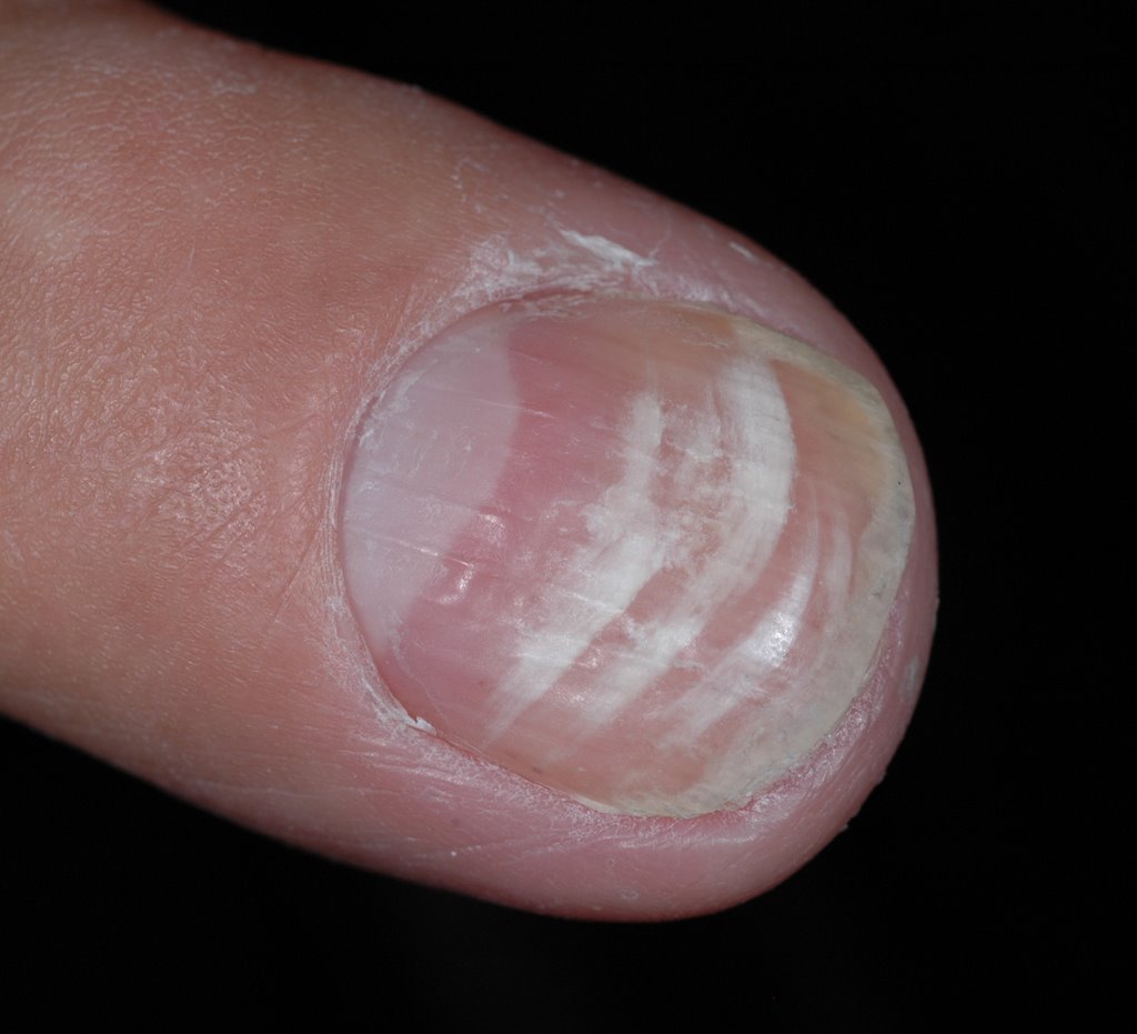 Fingernail streaks | MDedge Family Medicine