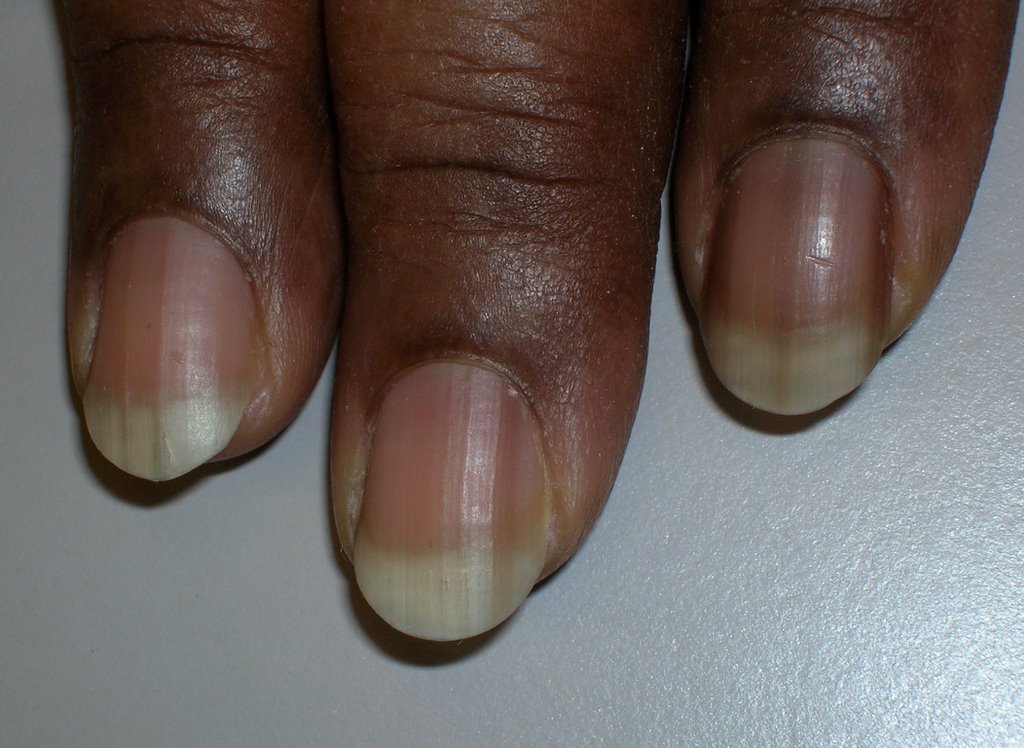 TIL that the white spots on finger nails are called Leukonychia, and are  harmless and most commonly caused by minor injuries that occur while the  nail is growing. Contrary to popular belief,