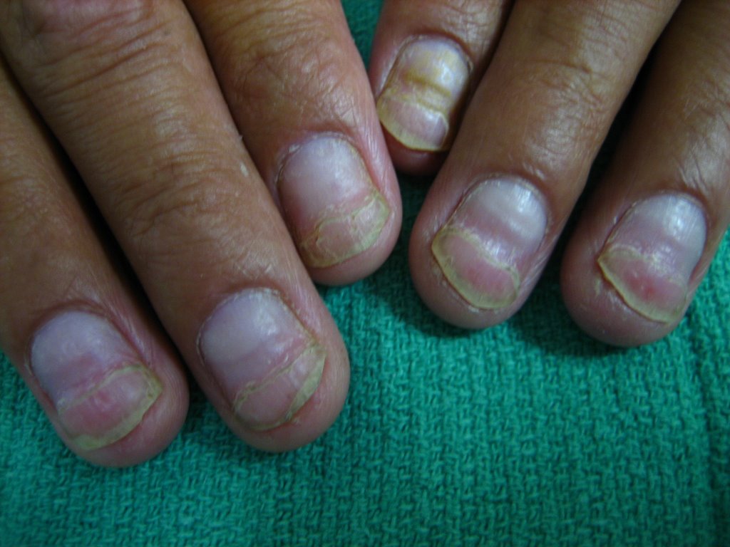 Given that fingernails grow approximately 2 to 3 mm per month, the physiolo...