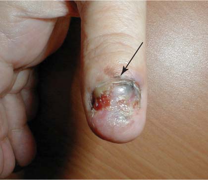 Abnormal thumb | MDedge Family Medicine