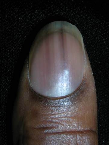 Dark lines on nails | MDedge Family Medicine
