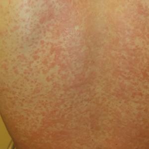 Man, 25, With Sinus Pain, Sore Throat, and Rash | MDedge