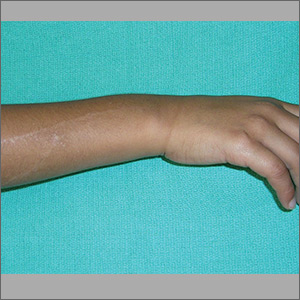 Rash on forearm