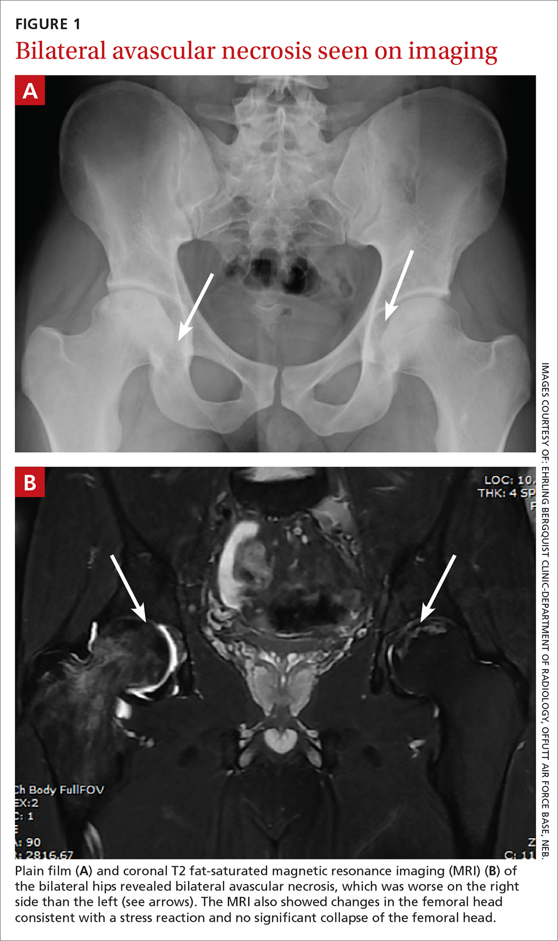 Bilateral avascular necrosis seen on imaging