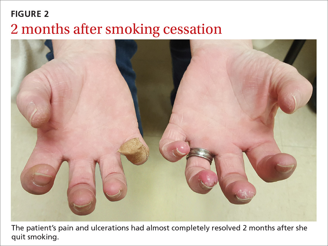 2 months after smoking cessation