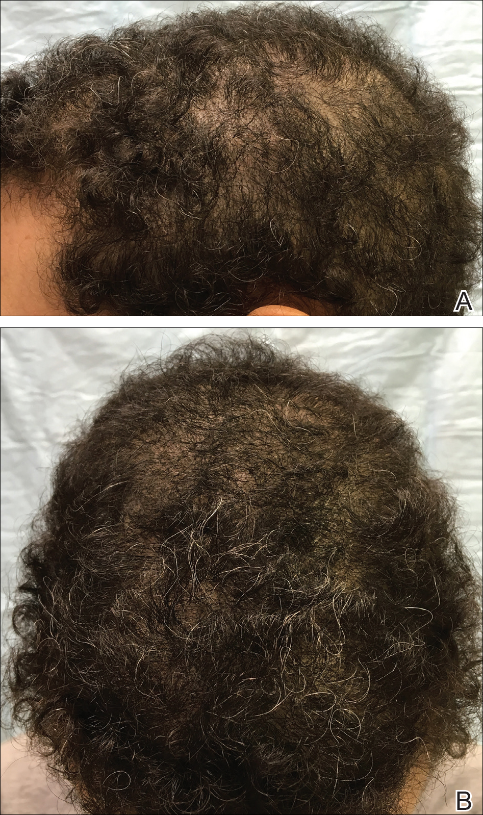 Nonscarring Alopecia Associated With Vitamin D Deficiency | MDedge  Dermatology