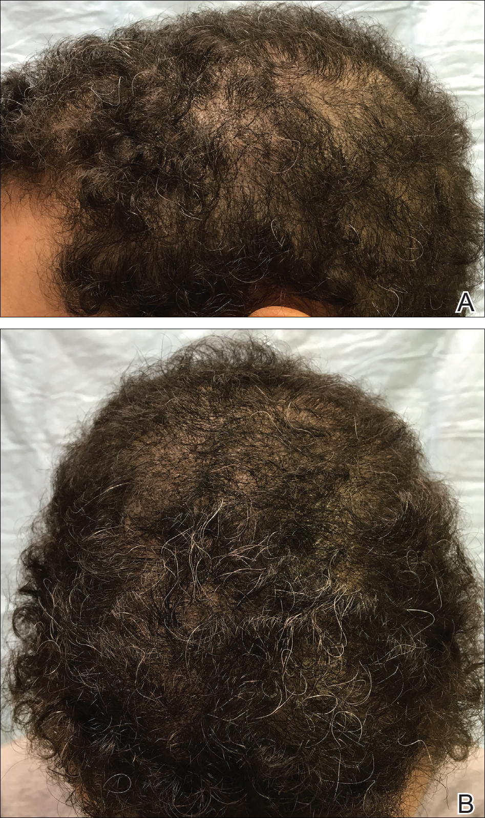 Hair Loss Treatment in Brownwood TX  Hair Restoration in Abilene TX