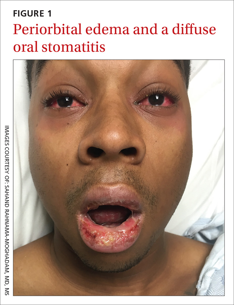 Periorbital edema and a diffuse oral stomatitis image