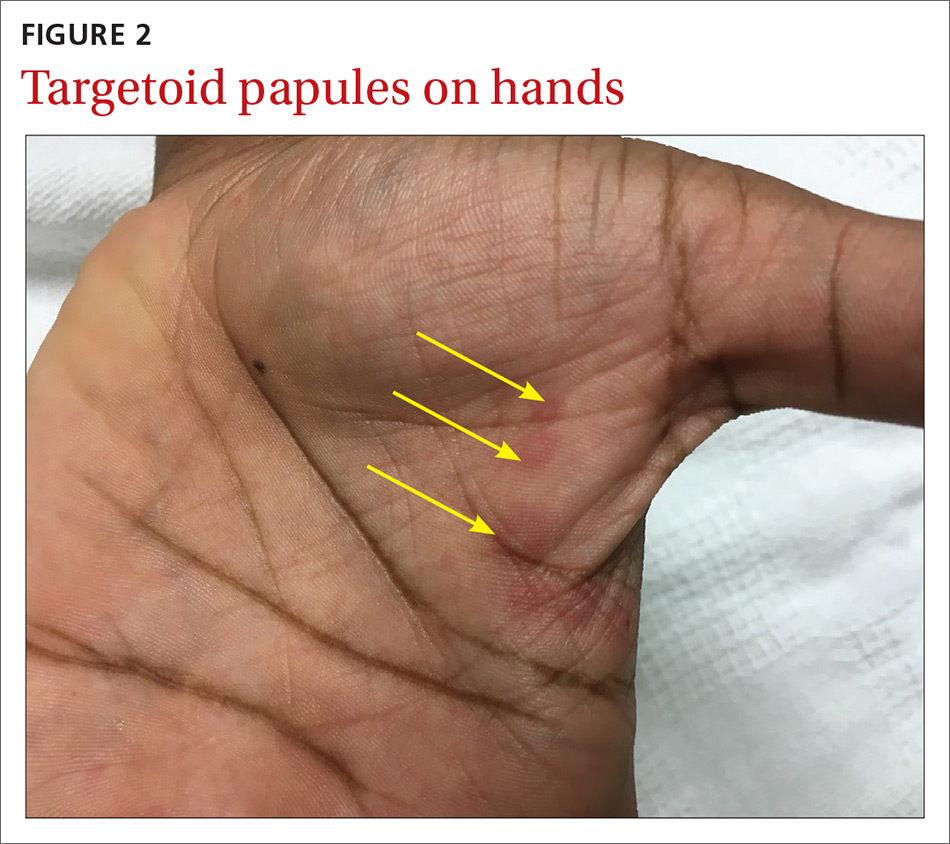 Targetoid papules on hands image