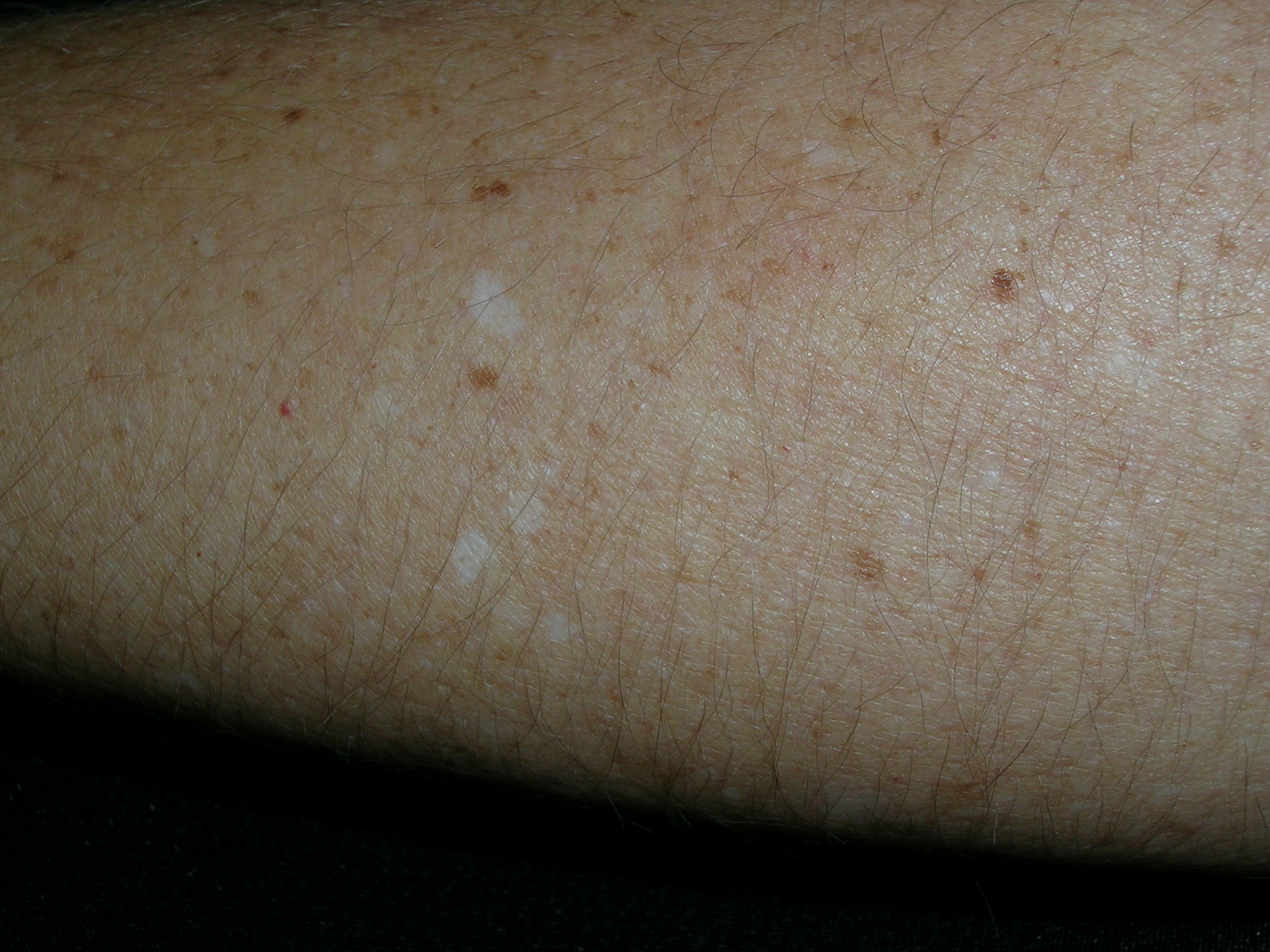 White Spots On Skin Causes Treatments Prevention Atelier yuwa ciao jp