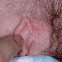 Growth behind infant’s ear