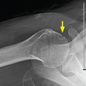 Pain in right shoulder